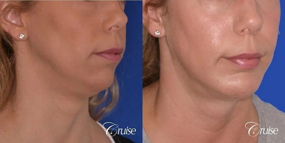 Chin Augmentation Before & After
