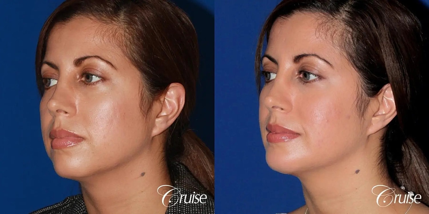 Chin Augmentation Before & After
