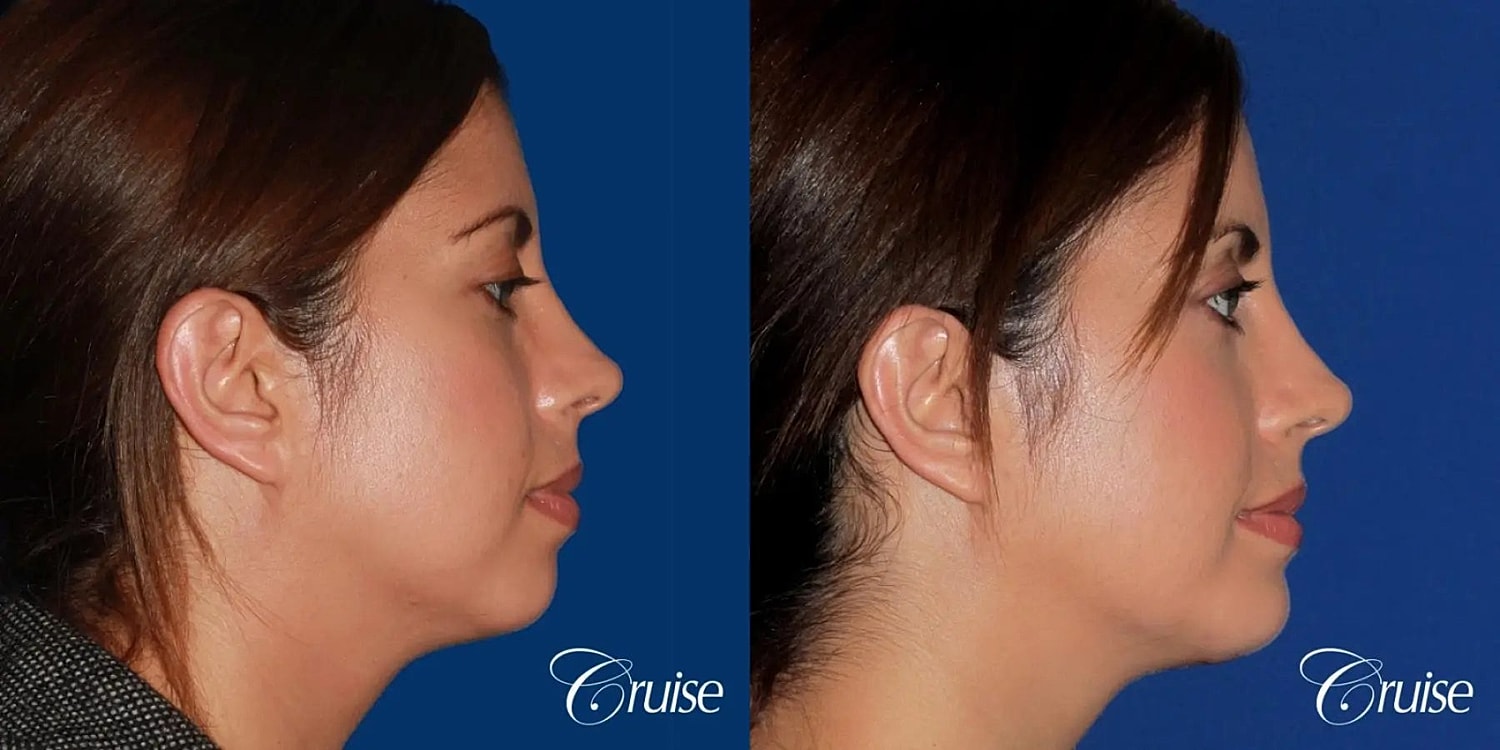 Chin Augmentation Before & After