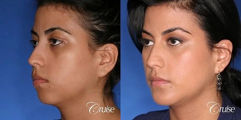 Chin Augmentation Before & After