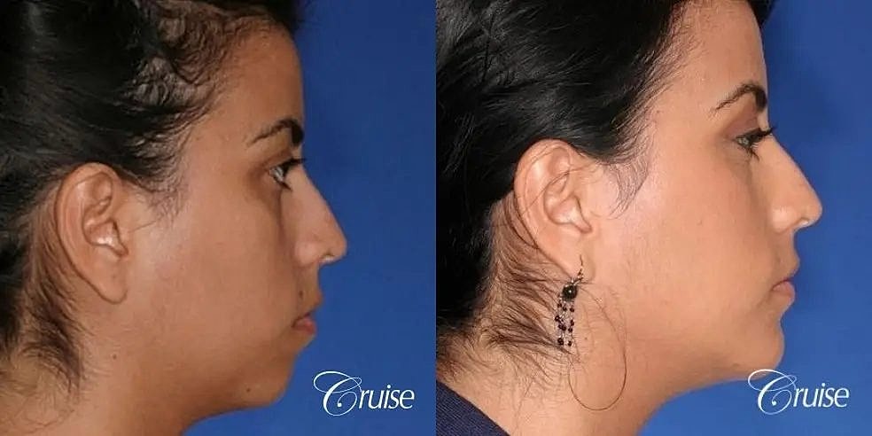 Chin Augmentation Before & After