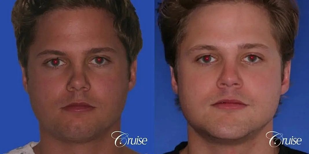 Chin Augmentation Before & After