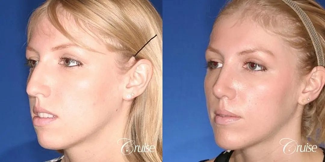 Chin Augmentation Before & After