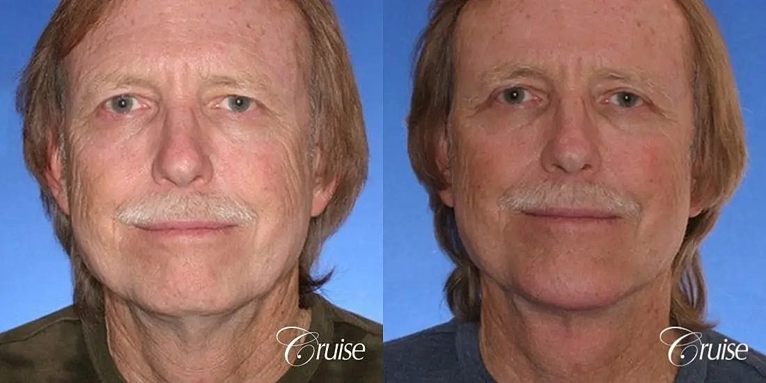 Chin Augmentation Before & After