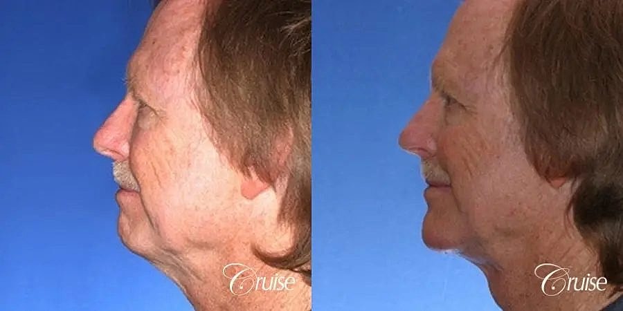 Chin Augmentation Before & After