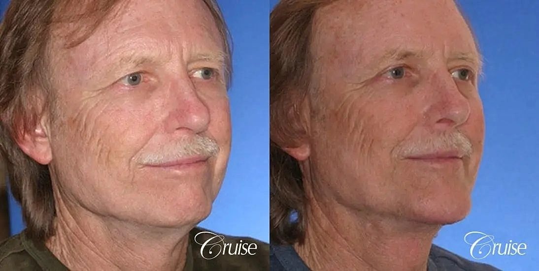 Chin Augmentation Before & After