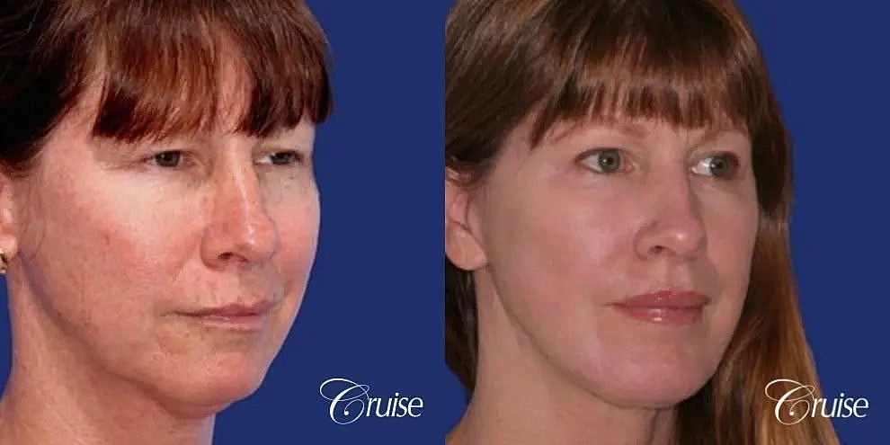 Chin Augmentation Before & After