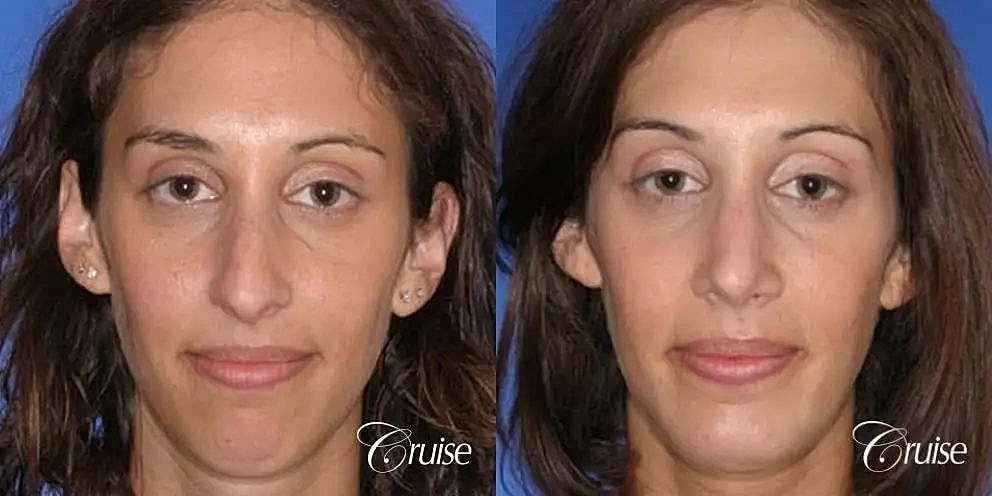 Chin Augmentation Before & After