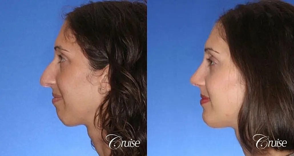 Chin Augmentation Before & After