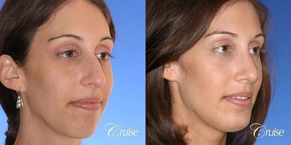 Chin Augmentation Before & After