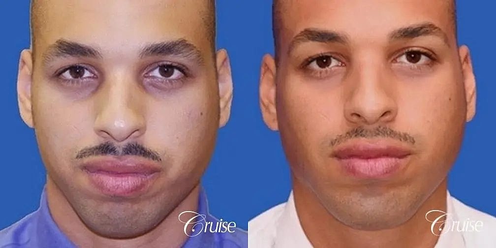 Chin Augmentation Before & After
