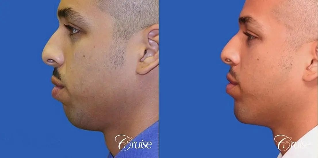 Chin Augmentation Before & After