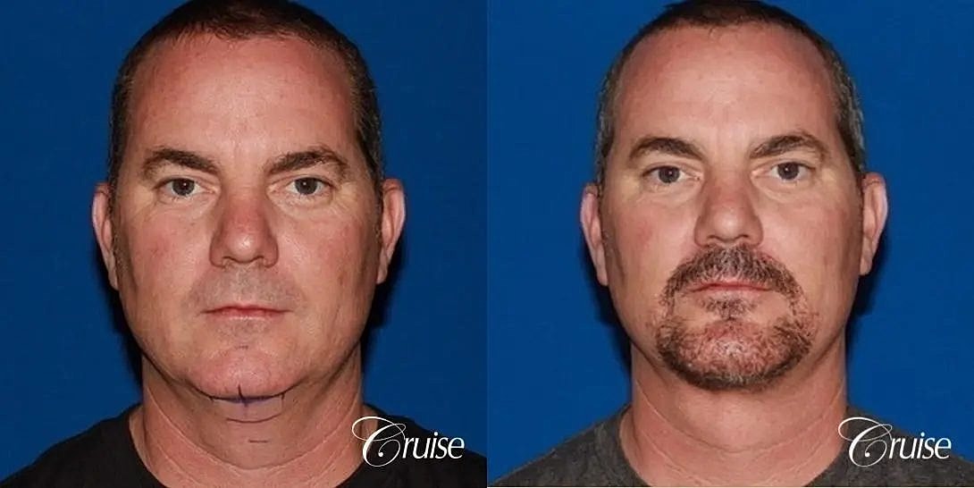 Chin Augmentation Before & After