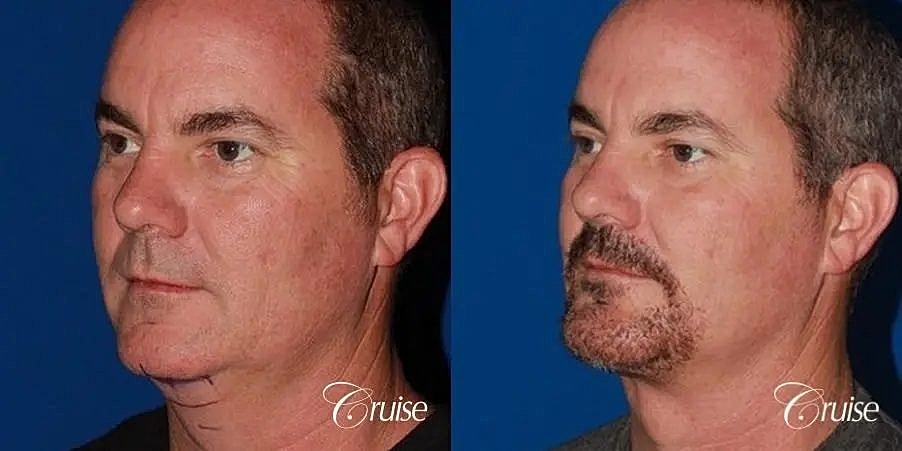 Chin Augmentation Before & After