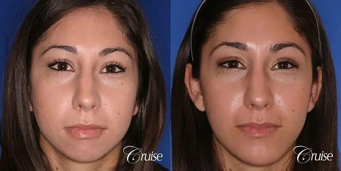 Chin Augmentation Before & After