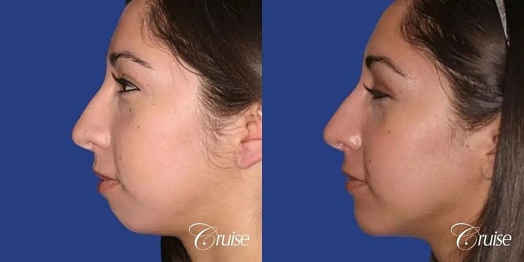 Chin Augmentation Before & After