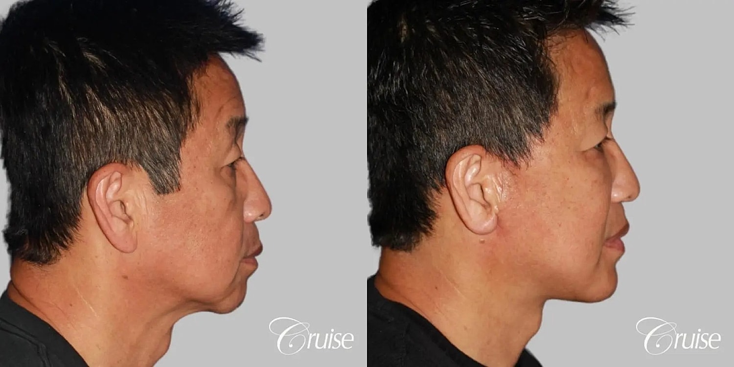 Chin Augmentation Before & After