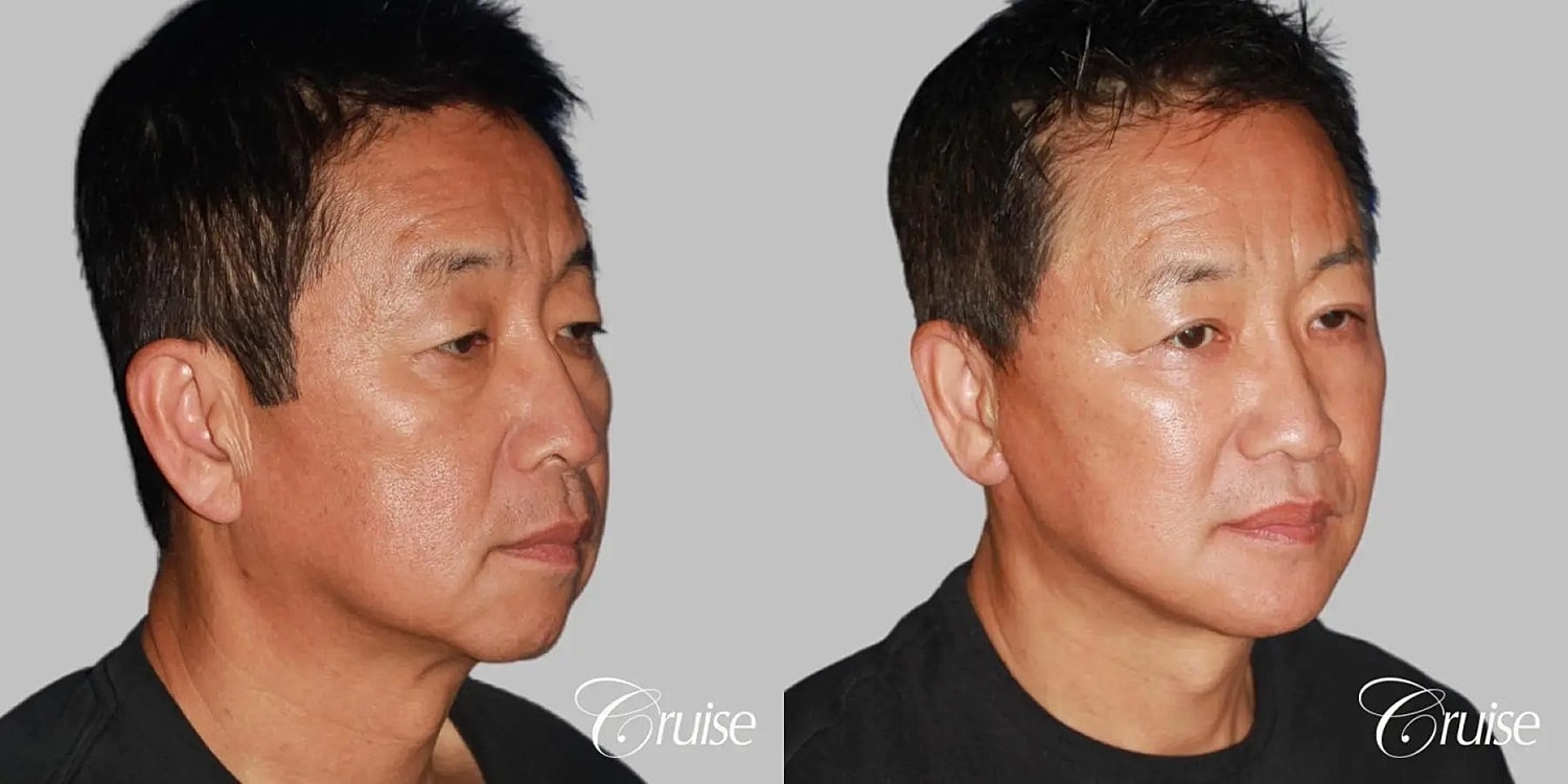 Chin Augmentation Before & After