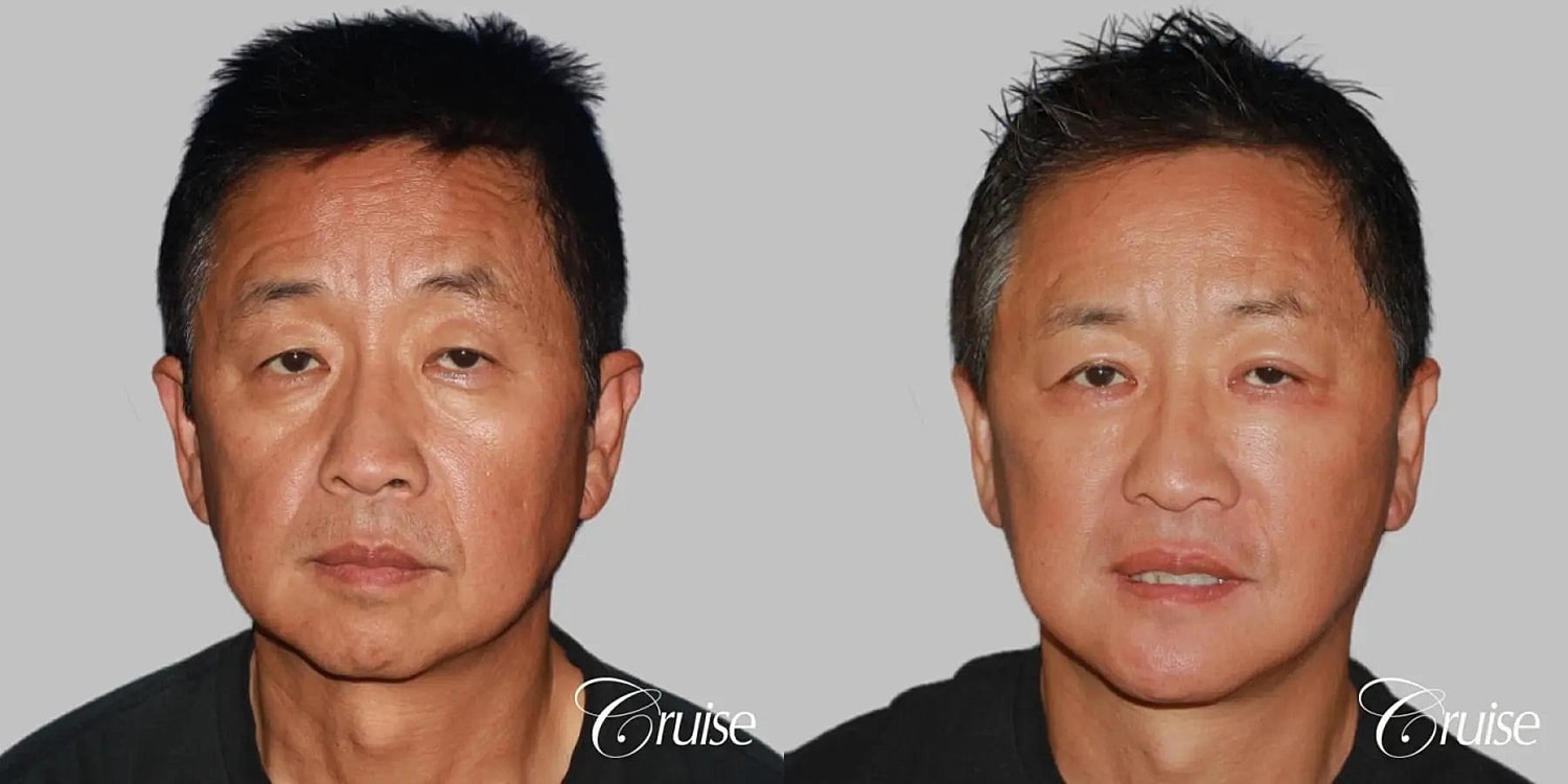 Chin Augmentation Before & After