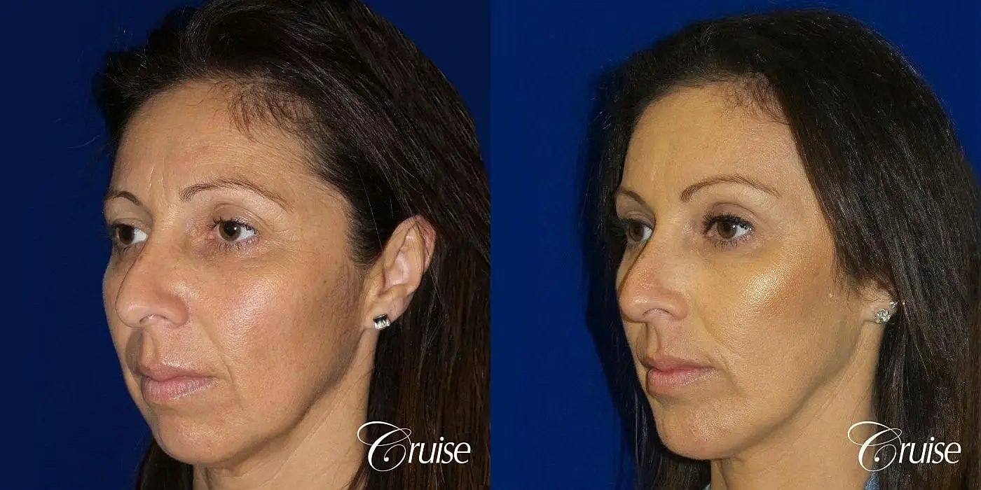 Brow Lift Before & After