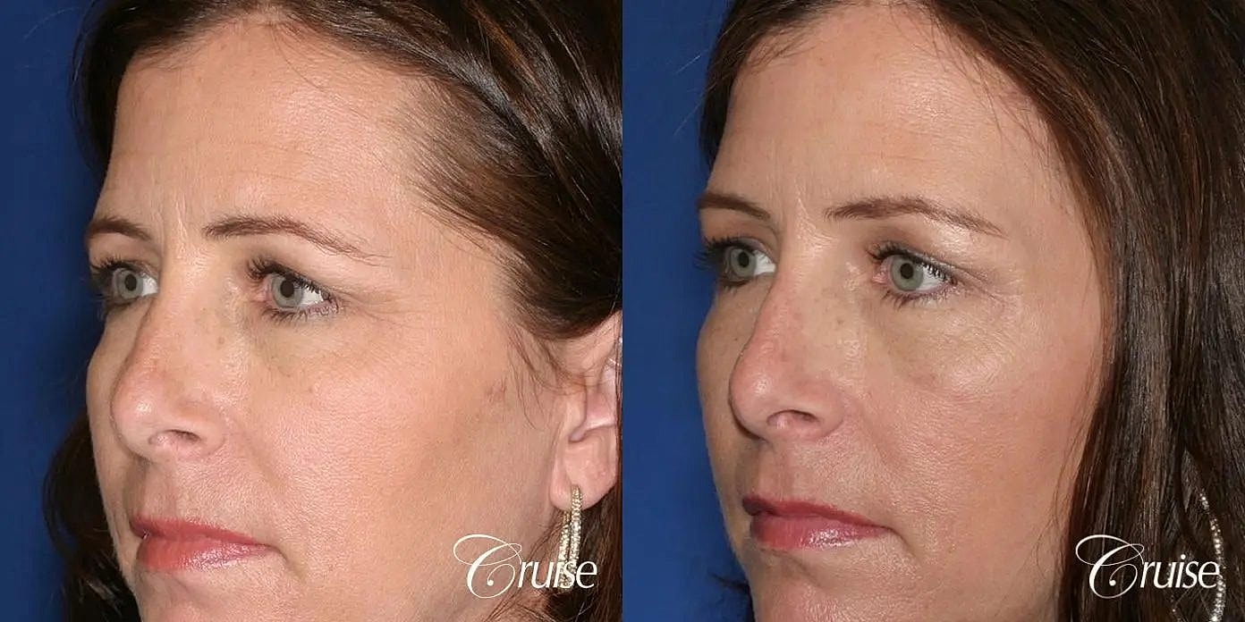 Brow Lift Before & After