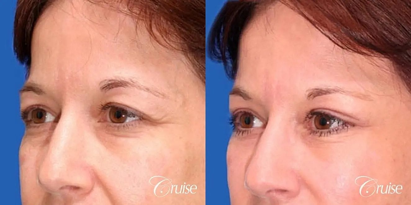 Brow Lift Before & After