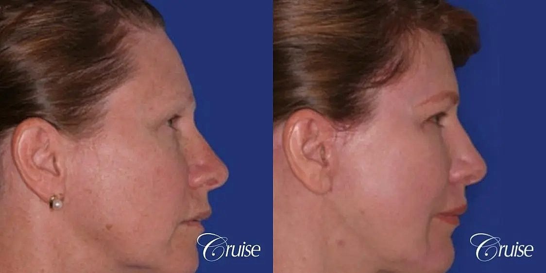 Brow Lift Before & After