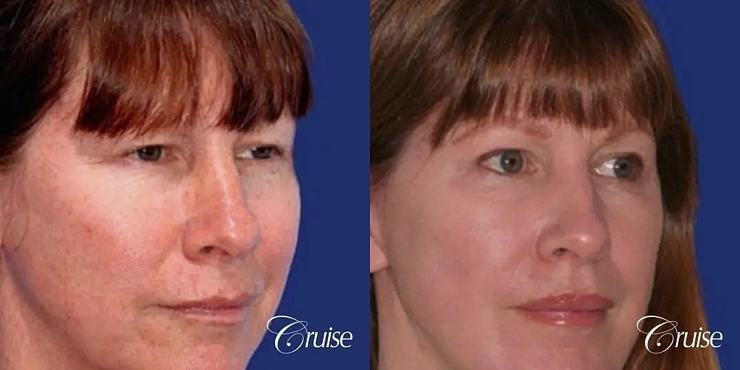 Brow Lift Before & After