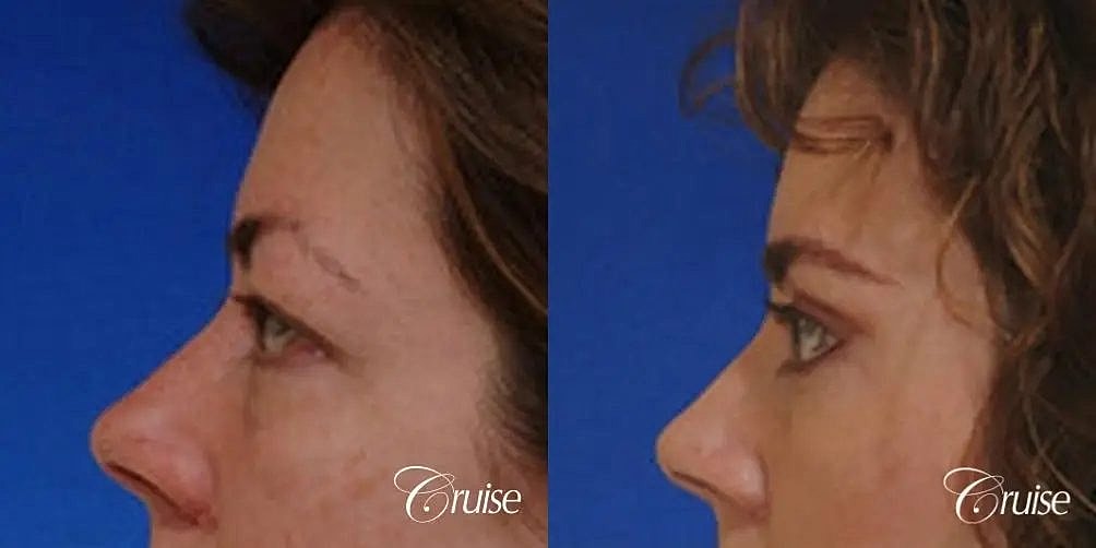 Brow Lift Before & After