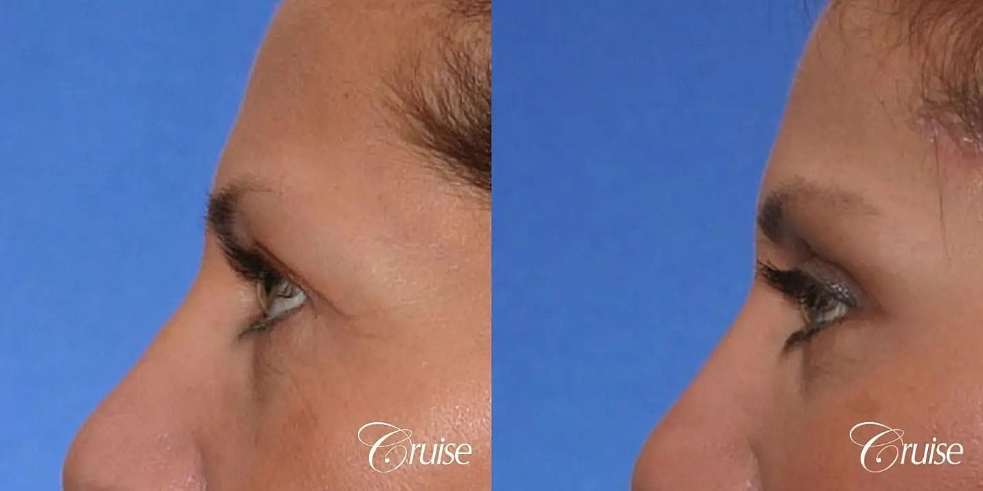 Brow Lift Before & After