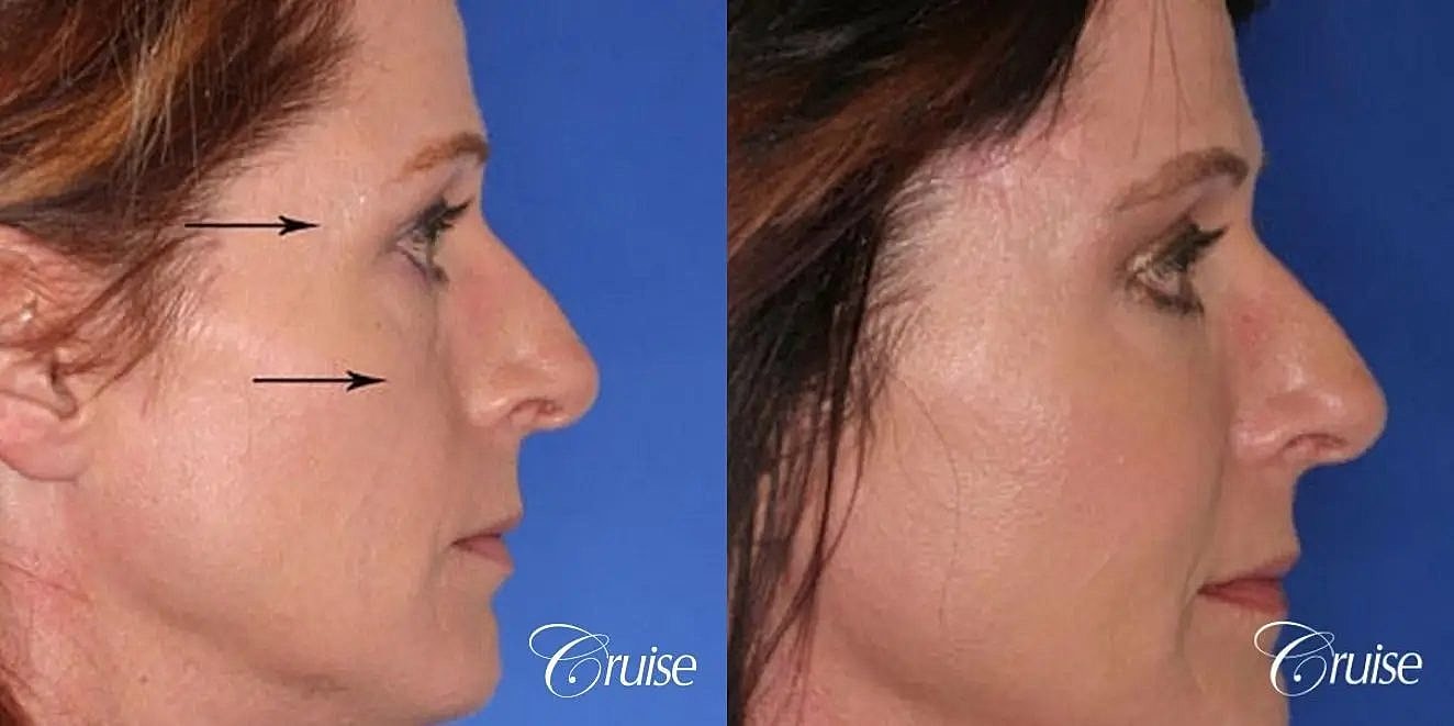 Brow Lift Before & After