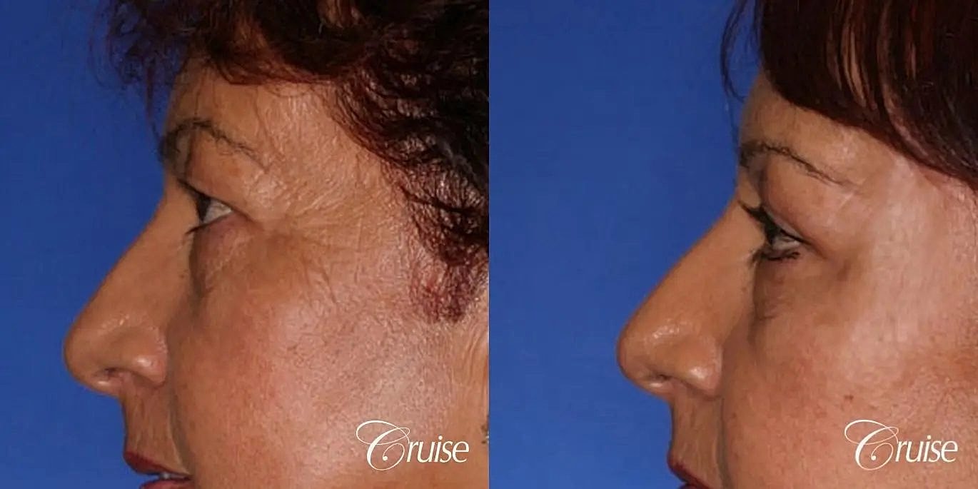 Brow Lift Before & After