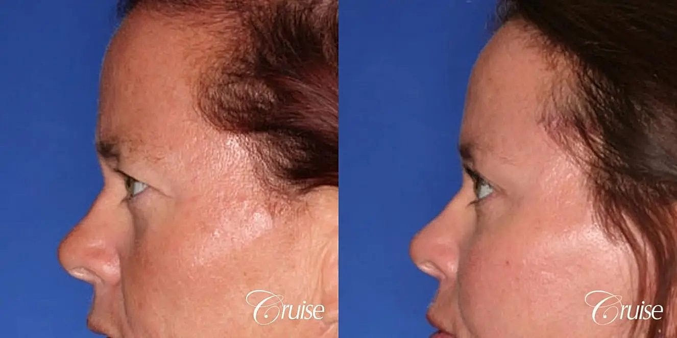 Brow Lift Before & After