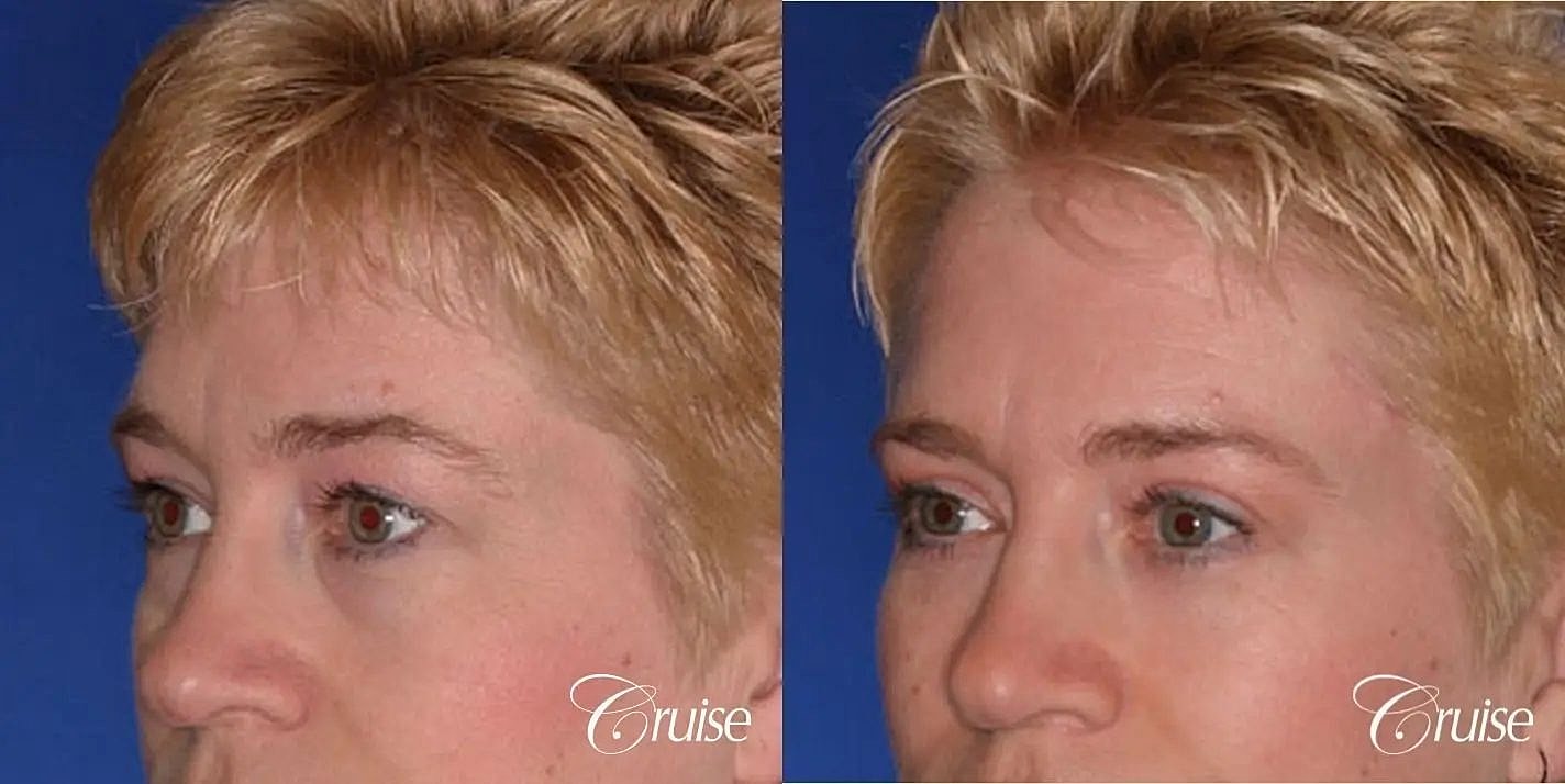Brow Lift Before & After