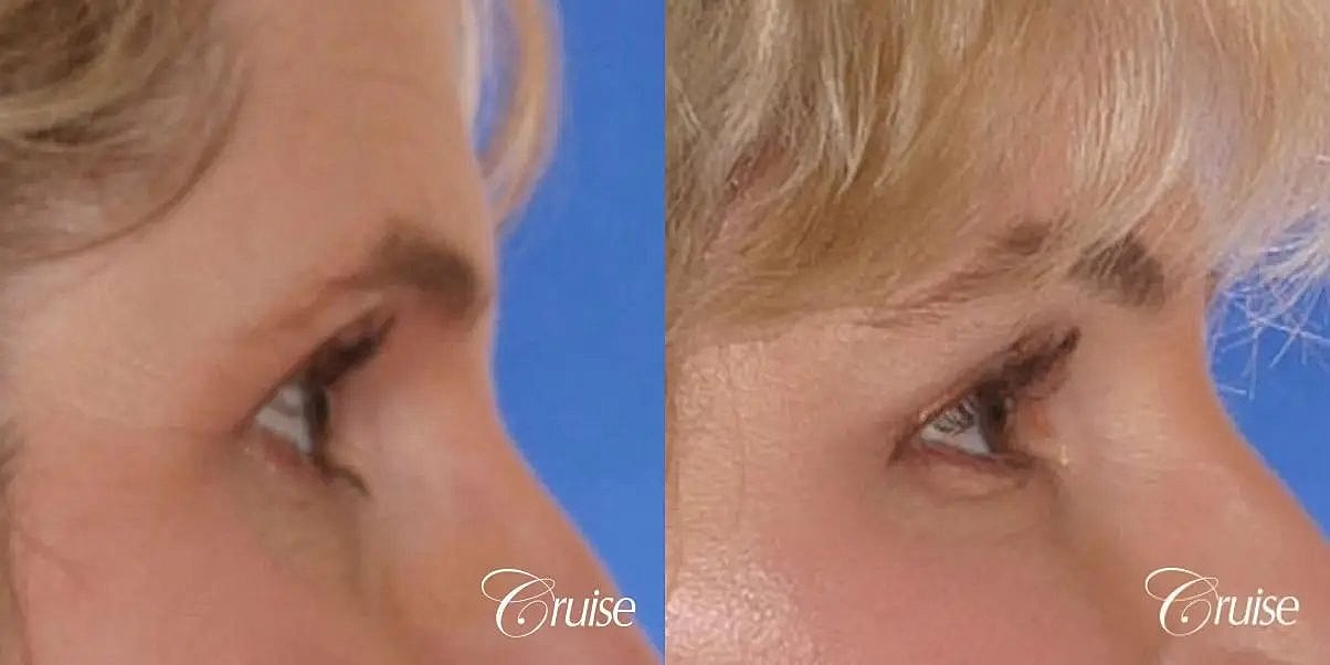 Brow Lift Before & After