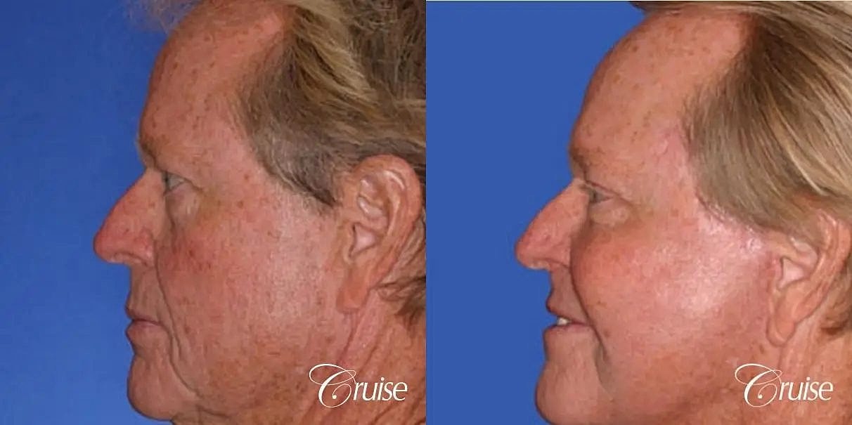 Brow Lift Before & After