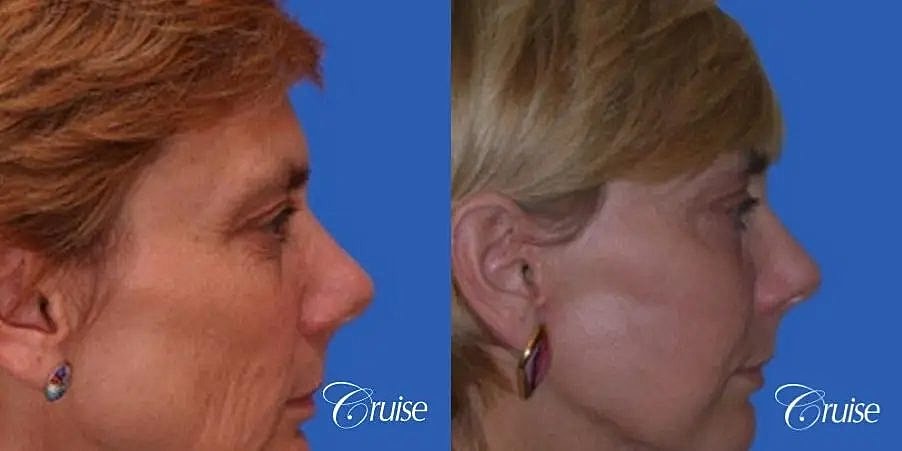 Brow Lift Before & After