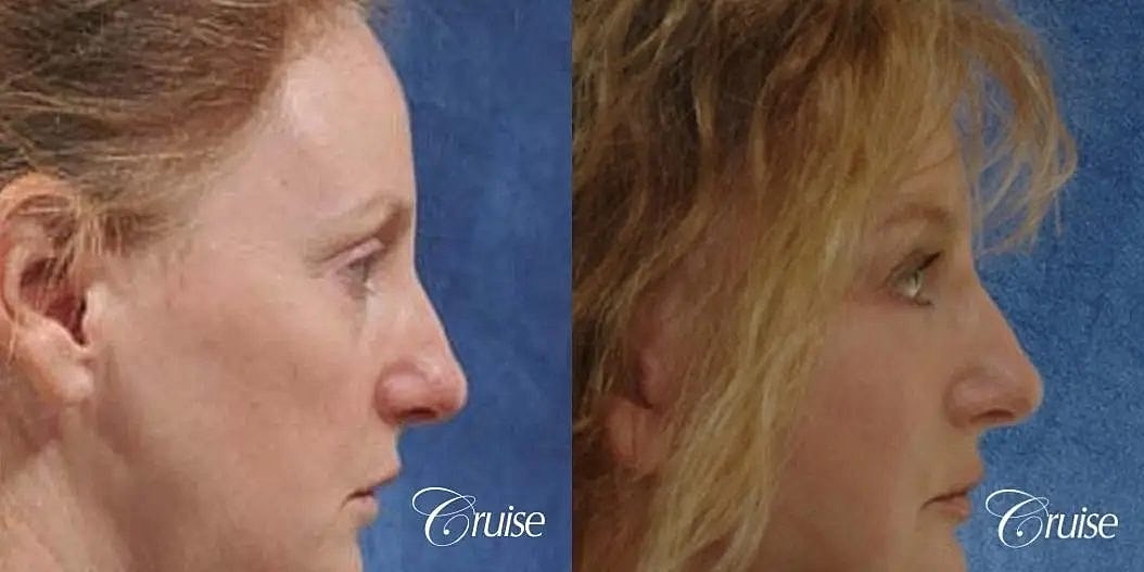 Brow Lift Before & After