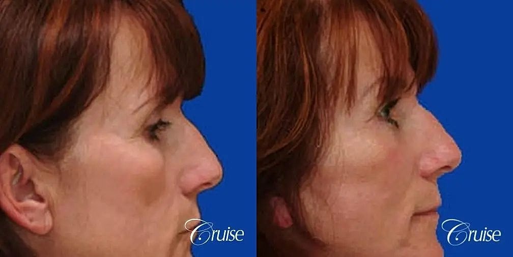 Brow Lift Before & After