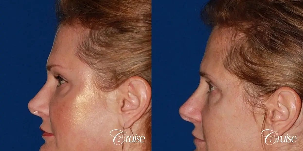 Brow Lift Before & After