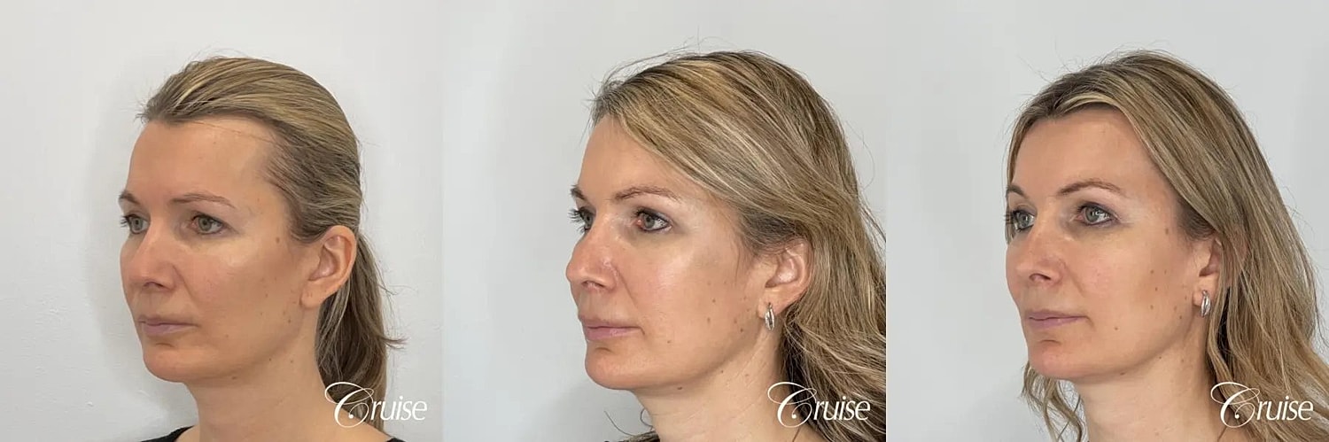 Brow Lift Before & After