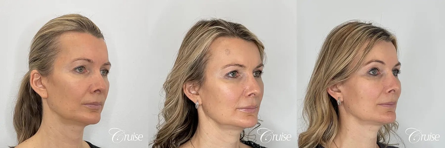 Brow Lift Before & After