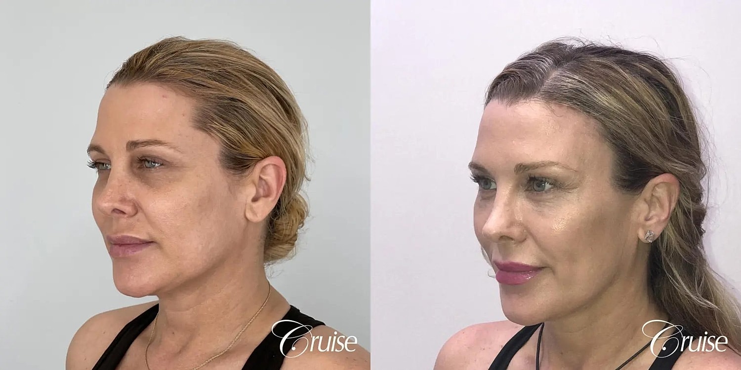 Brow Lift Before & After