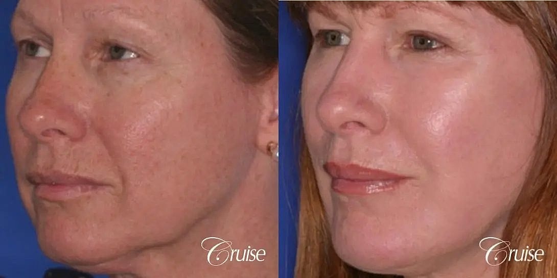 Chemical Peel Before & After