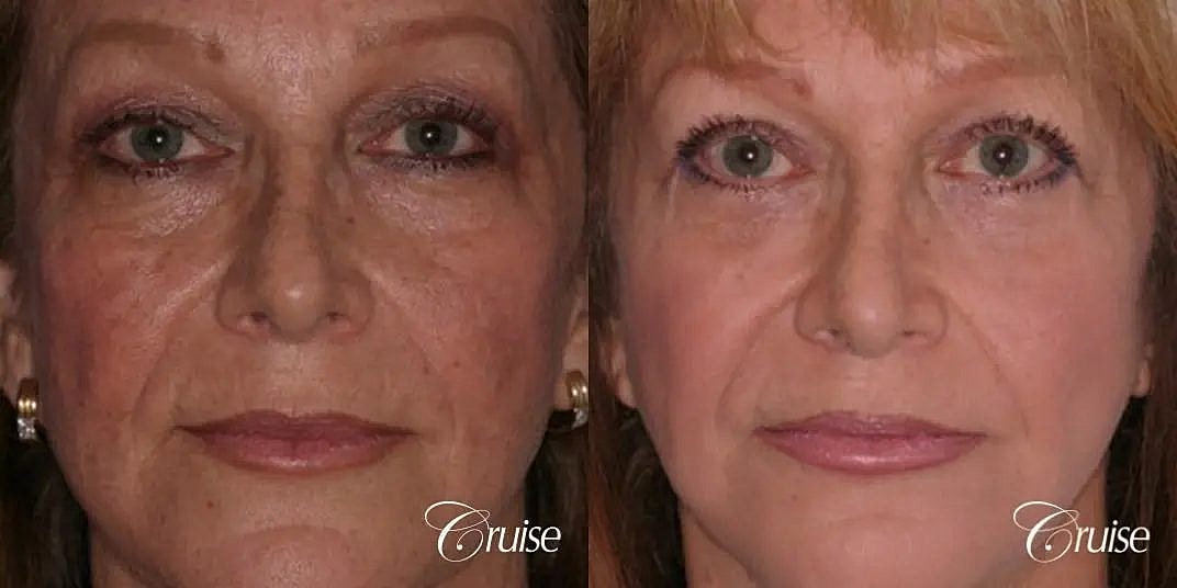 Chemical Peel Before & After