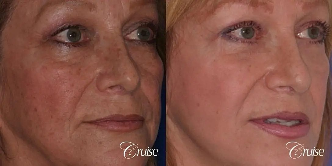 Chemical Peel Before & After