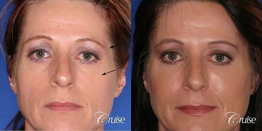 Chemical Peel Before & After