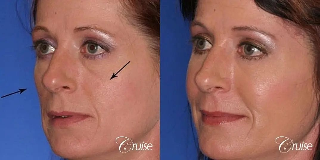 Chemical Peel Before & After