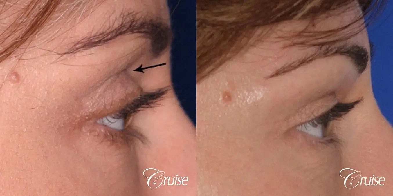 Dermal Fillers Before & After