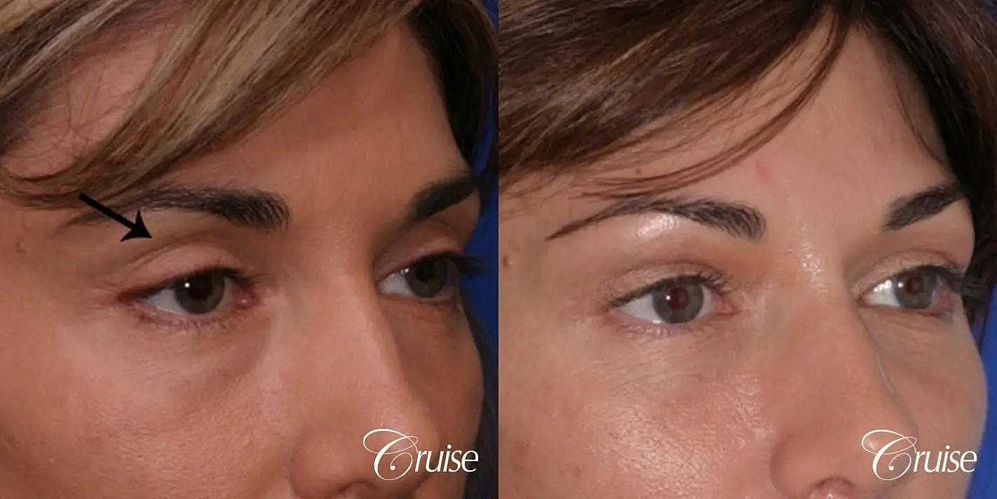 Dermal Fillers Before & After